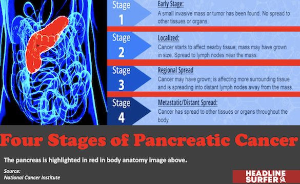 Four stges of pancreatic cancer / Headline Surfer